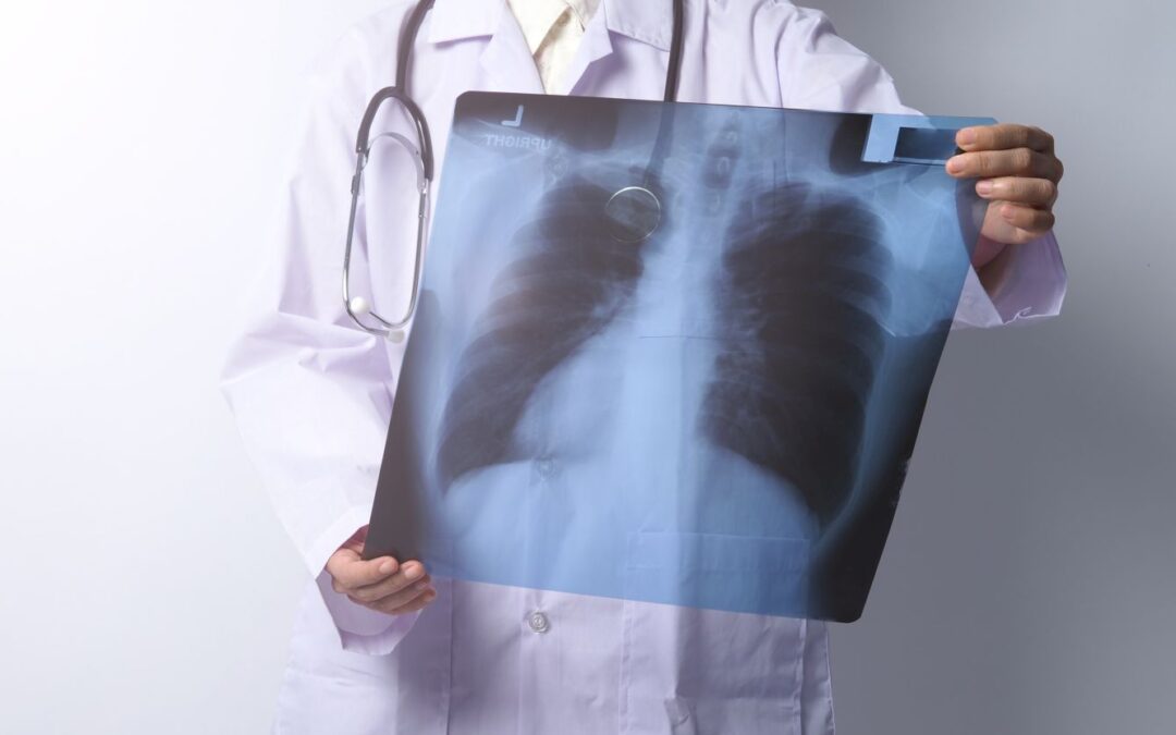 Doctor checking lung x-ray film from coronavirus pandemic.