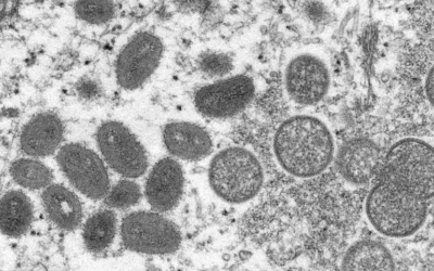 What is monkeypox, the rare virus now confirmed in the U.S. and Europe?