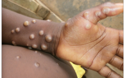 WHO reportedly convening emergency meeting on monkeypox